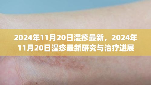 2024年濕疹最新研究與治療進(jìn)展