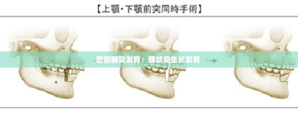面部髁突發(fā)育：髁狀突生長發(fā)育 