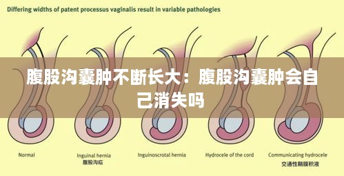 腹股溝囊腫不斷長大：腹股溝囊腫會(huì)自己消失嗎 
