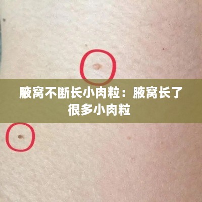腋窩不斷長(zhǎng)小肉粒：腋窩長(zhǎng)了很多小肉粒 