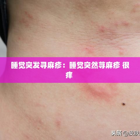 睡覺突發(fā)尋麻疹：睡覺突然蕁麻疹 很癢 
