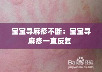 寶寶尋麻疹不斷：寶寶尋麻疹一直反復(fù) 
