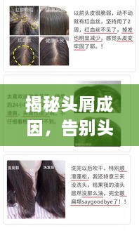 揭秘頭屑成因，告別頭屑如雨下的煩惱！