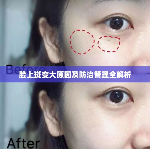 臉上斑變大原因及防治管理全解析