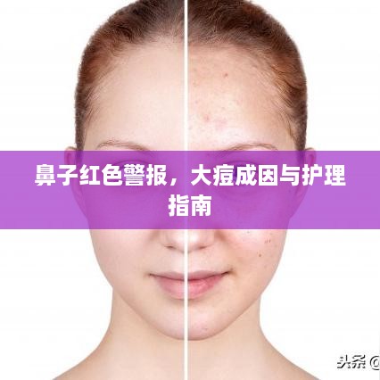 鼻子紅色警報(bào)，大痘成因與護(hù)理指南